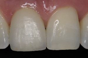 ATUALIZA��O EM PR�TESE SOBRE IMPLANTES 