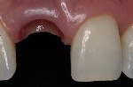 ATUALIZA��O EM PR�TESE SOBRE IMPLANTES 